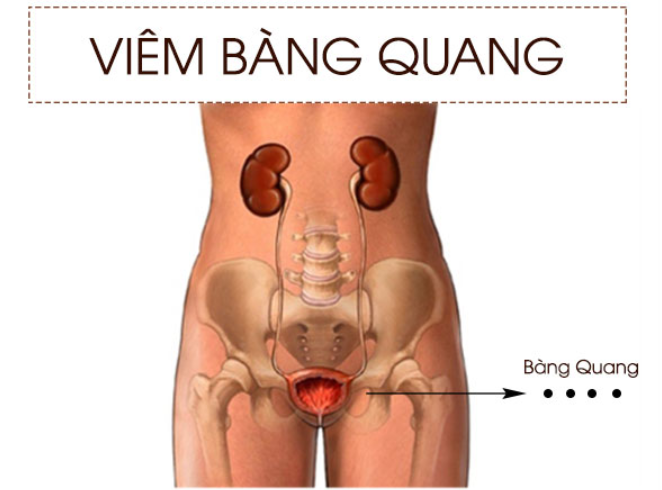 Bệnh viêm bàng quang là gì?