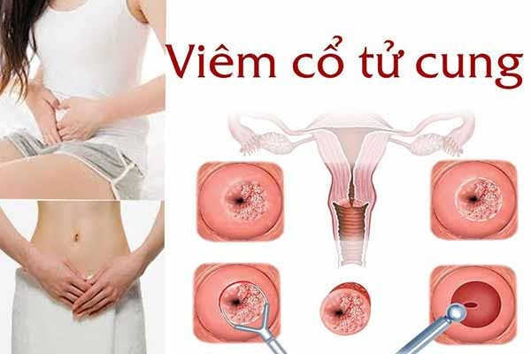 Viêm cổ tử cung là gì?