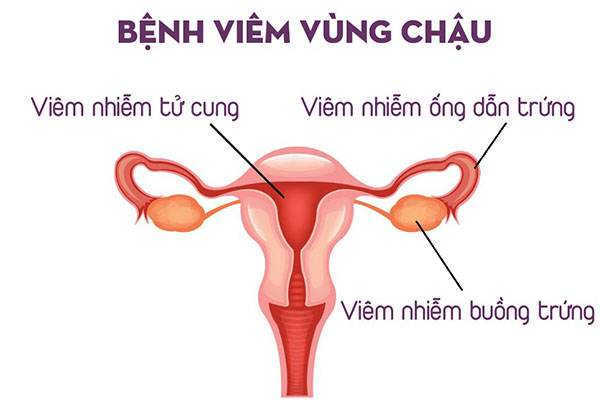 Dấu hiệu của viêm vùng chậu, viêm phần phụ