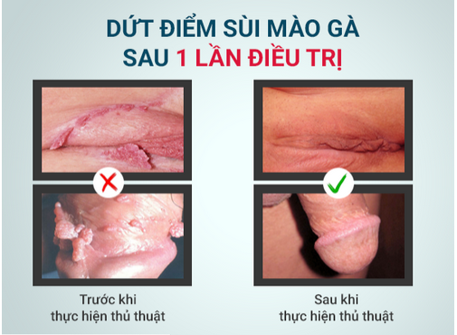 Sử dụng phương pháp IRA chữa sùi mào gà ở nữ giới giai đoạn đầu