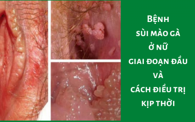 Bệnh sùi mào gà ở nữ giai đoạn đầu và cách điều trị