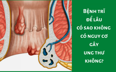 Bệnh Trĩ Để Lâu Có Sao Không – Có Nguy Cơ Gây Ung Thư Không?