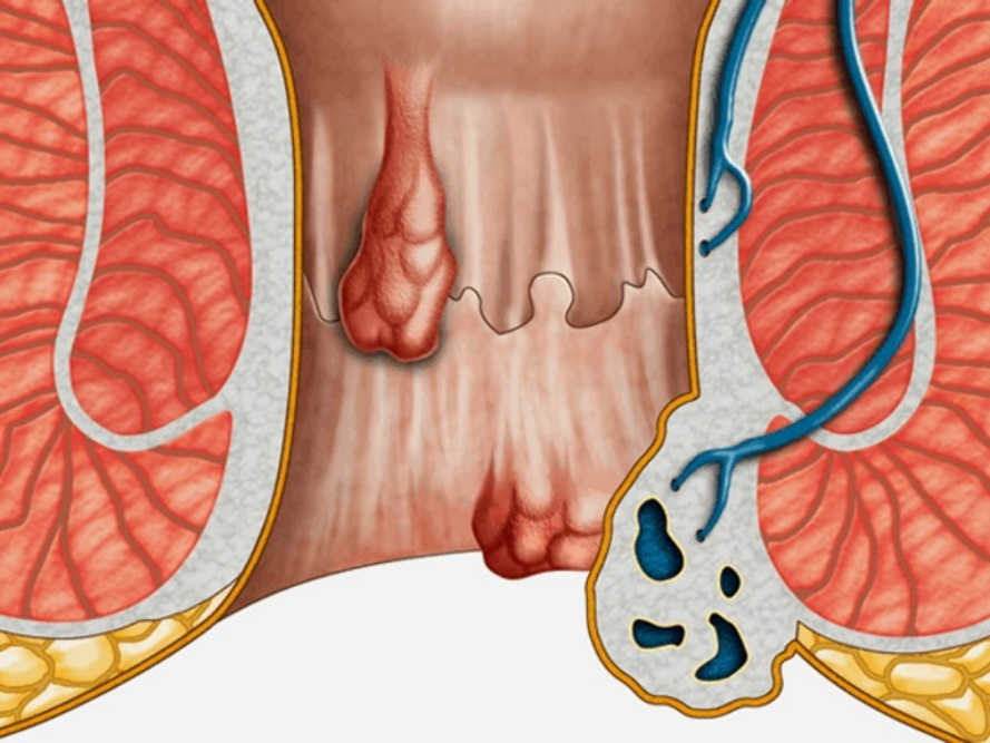 Tổng quan bệnh trĩ - những thông tin cần biết