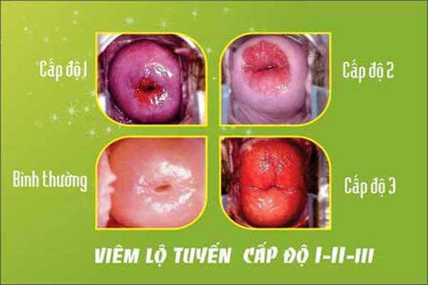 Triệu chứng của viêm lộ tuyến độ 3