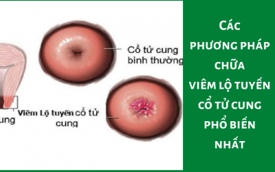 Các phương pháp chữa viêm lộ tuyến cổ tử cung phổ biến nhất