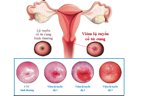 Viêm lộ tuyến độ 3 là gì?