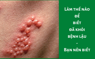 Làm thế nào để biết đã khỏi bệnh lậu – bạn nên biết