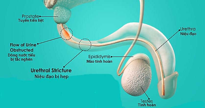 Nam giới bị hẹp niệu đạo