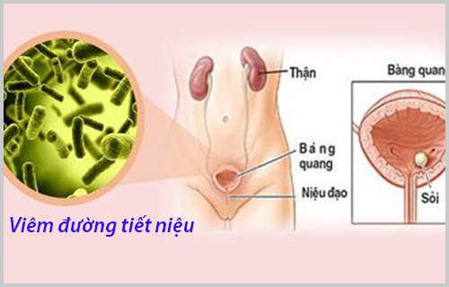 Nhiễm trùng đường tiểu có thật sự nguy hiểm?