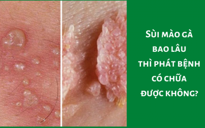 Sùi mào gà bao lâu thì phát bệnh, có chữa được không?