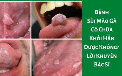 Bệnh Sùi Mào Gà Có Chữa Khỏi Hẳn Được Không?