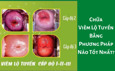 Chữa Viêm Lộ Tuyến Bằng Phương Pháp Nào Tốt Nhất?