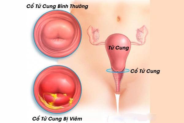 Không để lại sẹo ở cổ tử cung