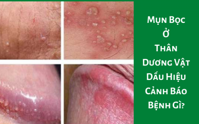 Mụn Bọc Ở Thân Dương Vật Dấu Hiệu Cảnh Báo Bệnh Gì?