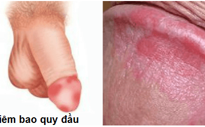 Cảnh báo nguy hiểm khi thấy hiện tượng viêm loét bao quy đầu