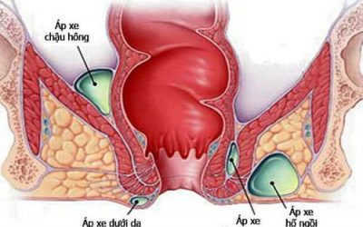 Mụn Apxe Hậu Môn Tự Vỡ Chữa Như Thế Nào? Dấu Hiệu Cần Biết