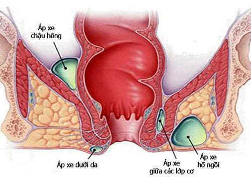 Apxe hậu môn