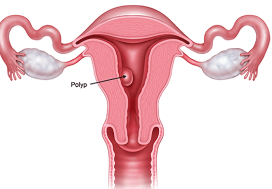 Bệnh Polyp tử cung