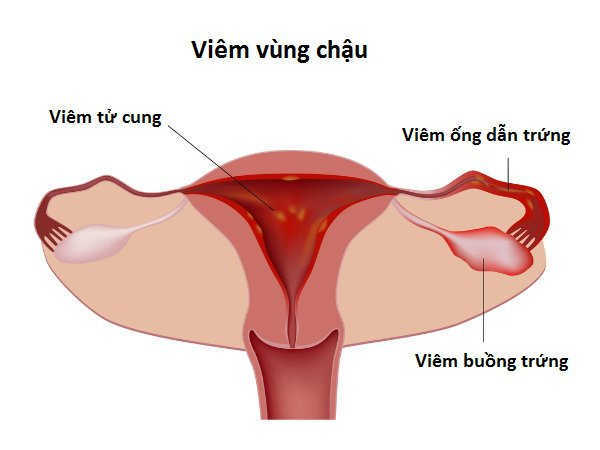 Triệu chứng của viêm vùng chậu