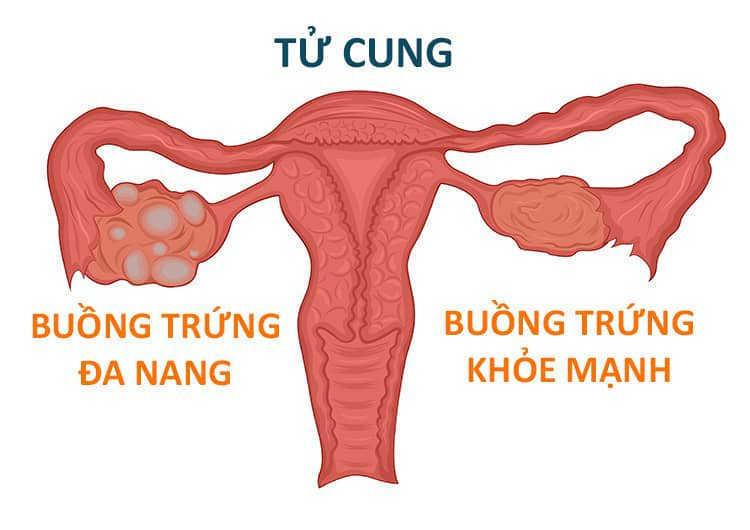 Buồng trứng đa nang có nguy hiểm không?