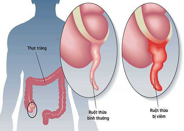 Đau vùng chậu dấu hiệu viêm ruột thừa