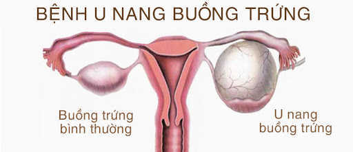 Kinh nguyệt ra từng mảng do U nang buồng trứng