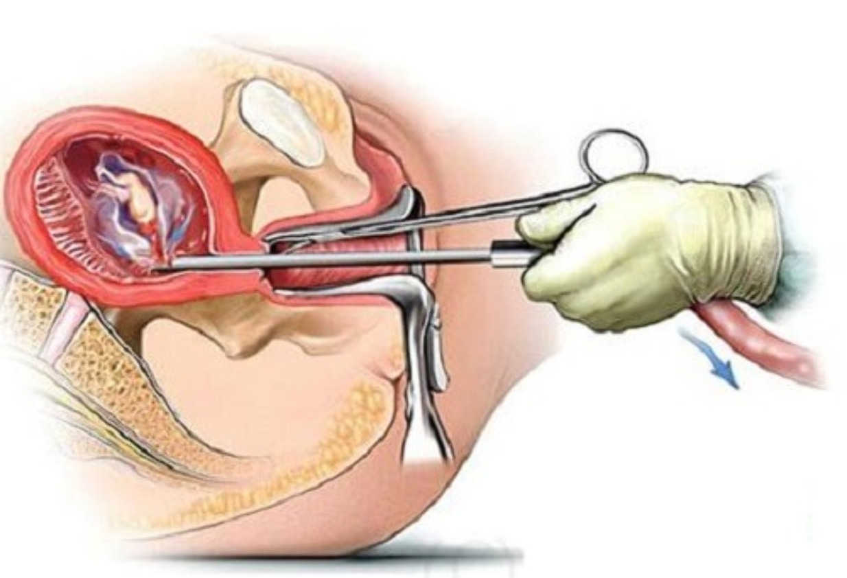 Nạo hút thai nhiều lần khiến tử cung, âm đạo đều tổn thương