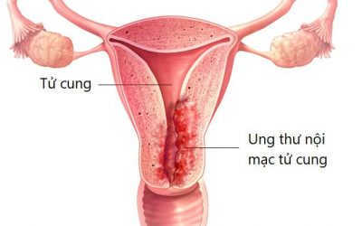 Cổ Tử Cung Có Nốt Sần Là Bệnh Gì? Cách Chữa Trị