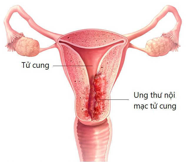 Nguy cơ ung thư nội mạc tử cung