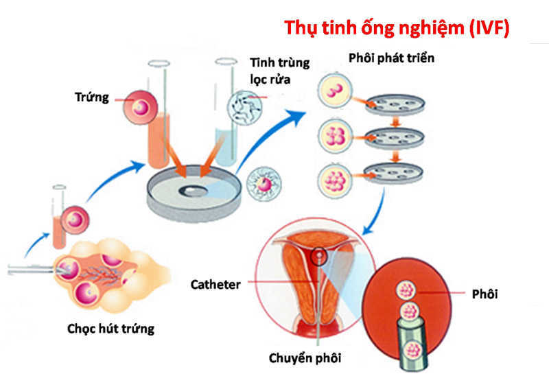 Phương pháp thụ tinh trong ống nghiệm