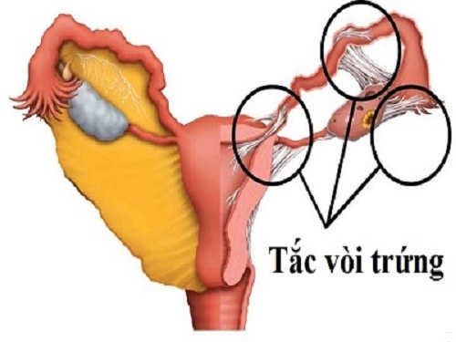 Tắc vòi trứng là gì