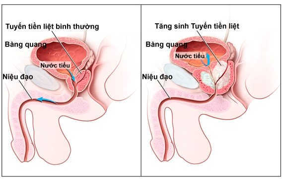 Tăng sản tiền liệt tuyến