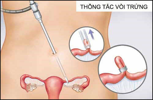 Thông tắc vòi trứng bằng phương pháp nội khoa