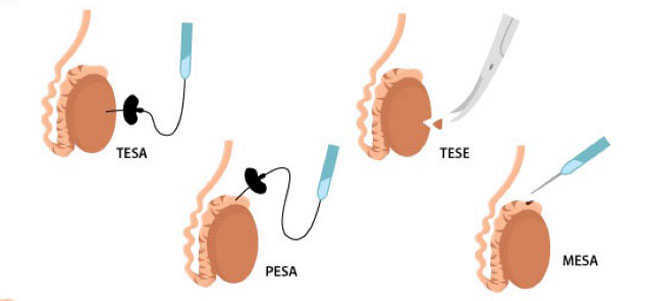 Thủ thuật PESA