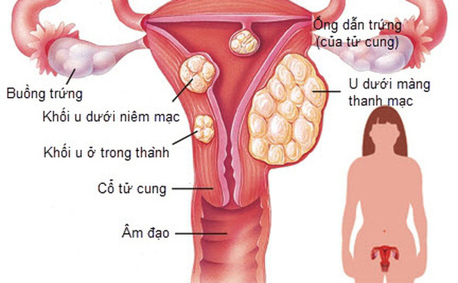 Kinh nguyệt ra từng mảng do U xơ tử cung