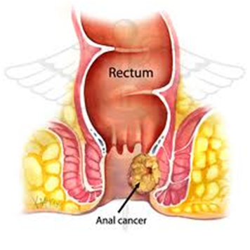 Ung thư hậu môn trực tràng