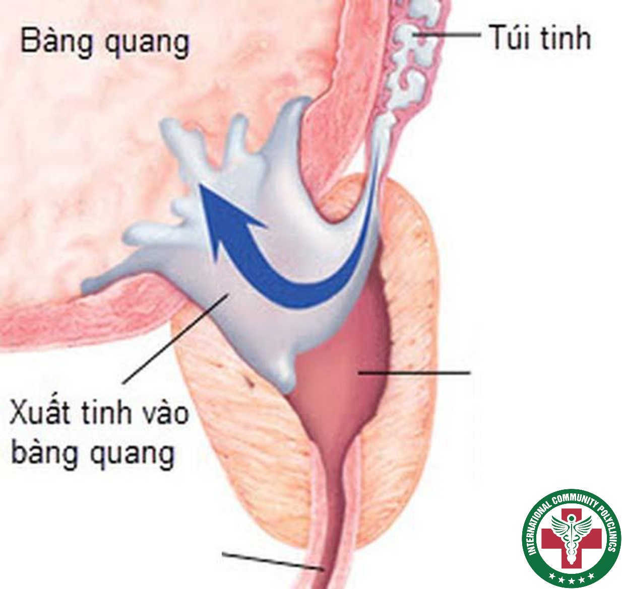 Nam giới bị mắc dị tật bẩm sinh không có ống dẫn tinh