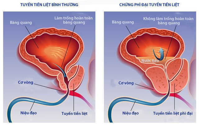 Bệnh Phì Đại Tuyến Tiền Liệt