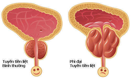 Bệnh Phì Đại Tuyến Tiền Liệt