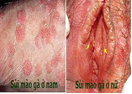 bệnh sùi mào gà