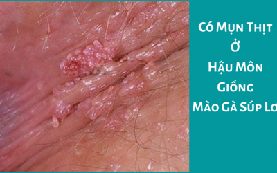 Có Mụn Thịt Ở Hậu Môn Giống Mào Gà Súp Lơ – Bác Sĩ Giải Đáp