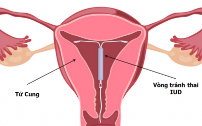 Dây Vòng Tránh Thai Thò Ra Ngoài Phải Làm Sao?