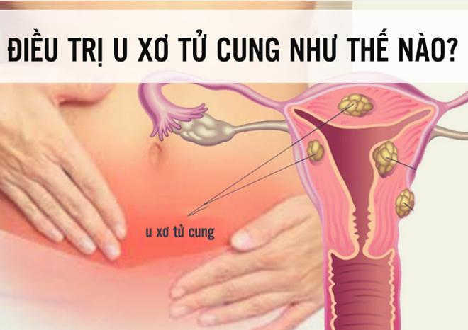 Điều trị u xơ cổ tử cung