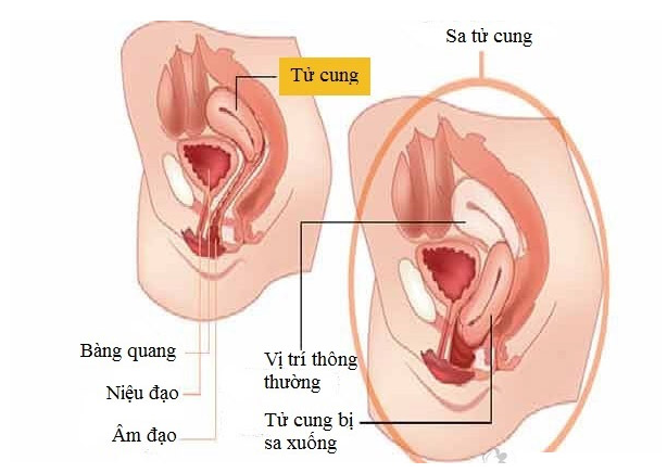 Do kích thước tử cung