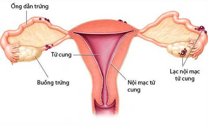 Lạc nội mạc tử cung