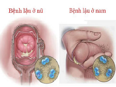 Mắc các bệnh lây truyền qua đường tình dục