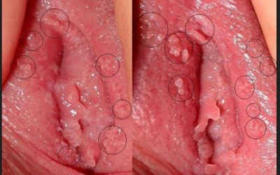 Mọc Mụn Ở Âm Đạo Có Chữa Được Không? – Bạn Nên Làm Gì?