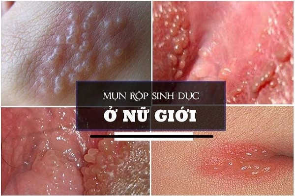 Mụn rộp mọc ở âm đạo