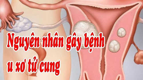 Nguyên nhân gây u xơ cổ tử cung