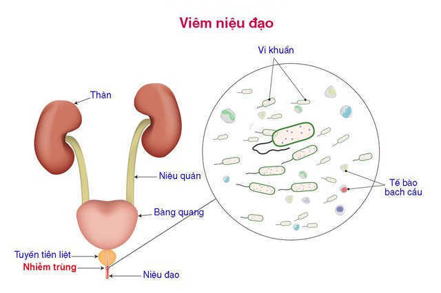 Nguyên nhân ngứa đường tiểu, viêm niệu đạo không do lậu